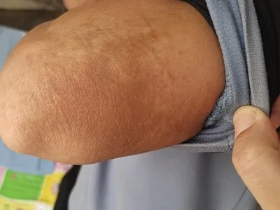 咖啡斑斑图片