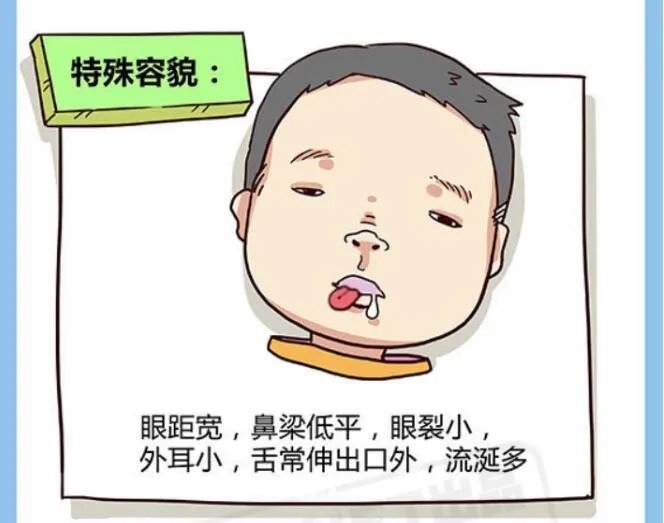 国际脸什么意思是什么病 弱智国际脸是怎么造成的