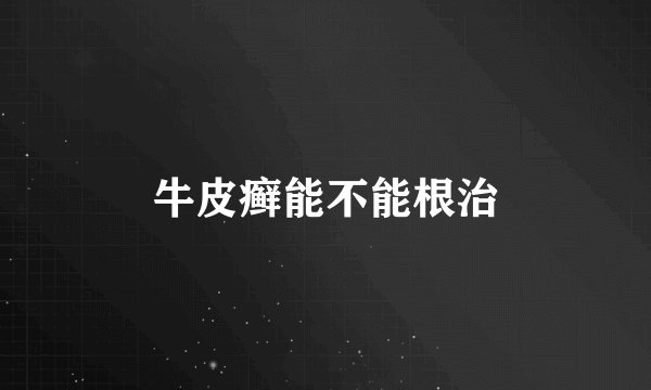牛皮癣能不能根治