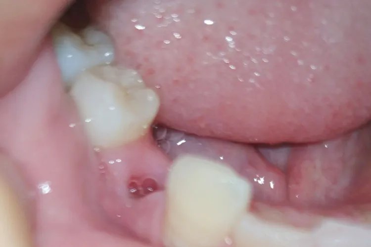 拔完牙恢复过程的图片