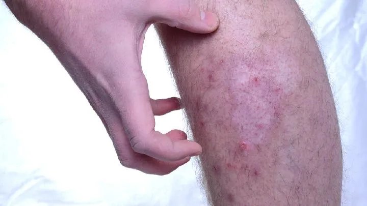 系统性红斑狼疮能治好吗?