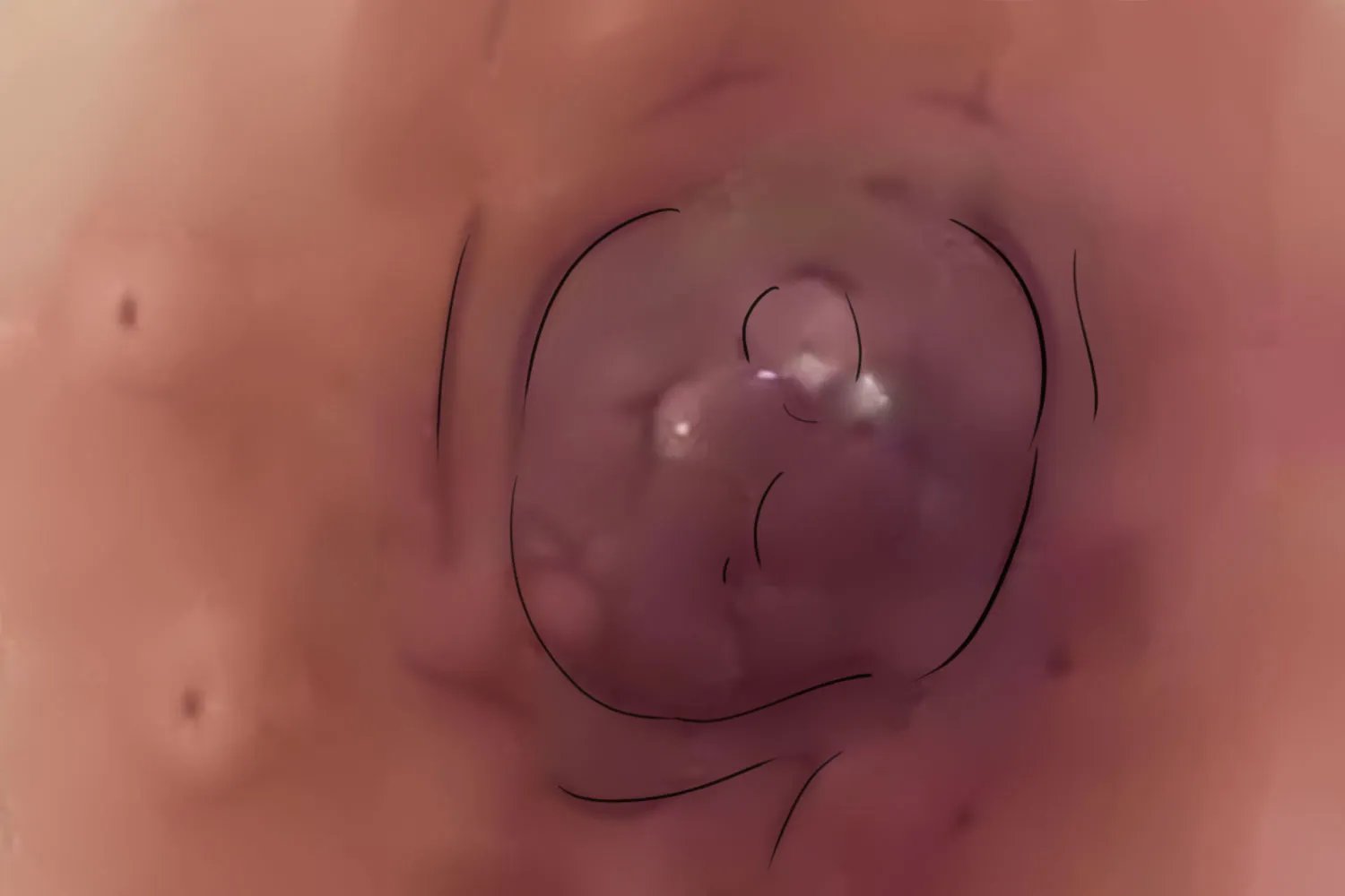 乳腺癌早期症状图片