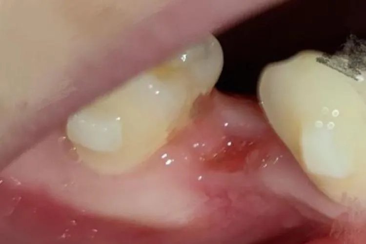 拔完牙恢复过程的图片