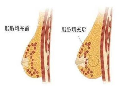 自体脂肪隆胸图片大全