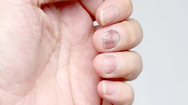 灰指甲的初期症状