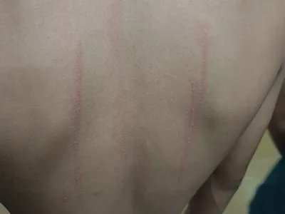 人工荨麻疹症状图片