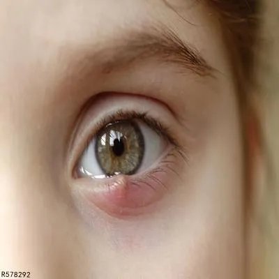 葡萄球菌烫伤样皮肤综合征如何治疗