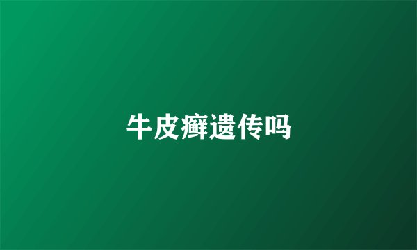 牛皮癣遗传吗