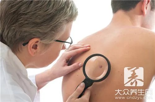 痣在脸上的位置所代表的意义