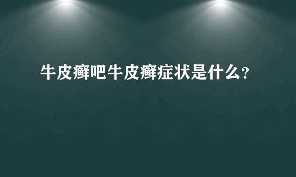 牛皮癣吧牛皮癣症状是什么？