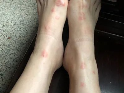 跳蚤叮咬疙瘩图片