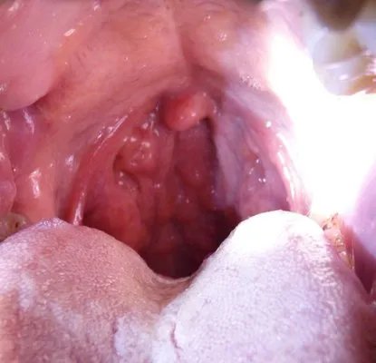食管憩室是什么意思？