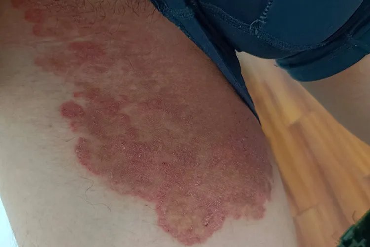 癣皮肤病图片