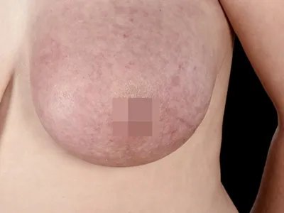 乳腺癌症状图片