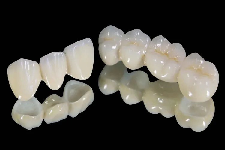 全瓷冠图片
