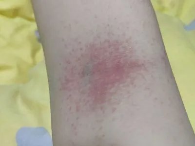 皮肤过敏红肿胳膊症状图片