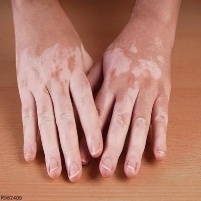 白癜风可以吃胸腺肽片治疗吗