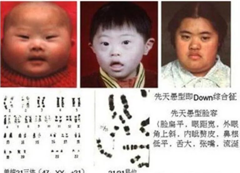 国际脸什么意思是什么病 弱智国际脸是怎么造成的
