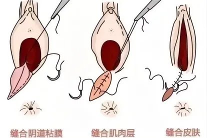顺产二度撕裂缝合图