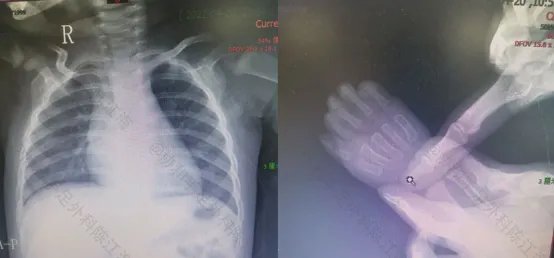 波兰综合征是什么
