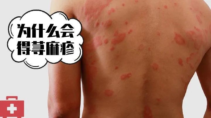 荨麻疹的症状和治疗