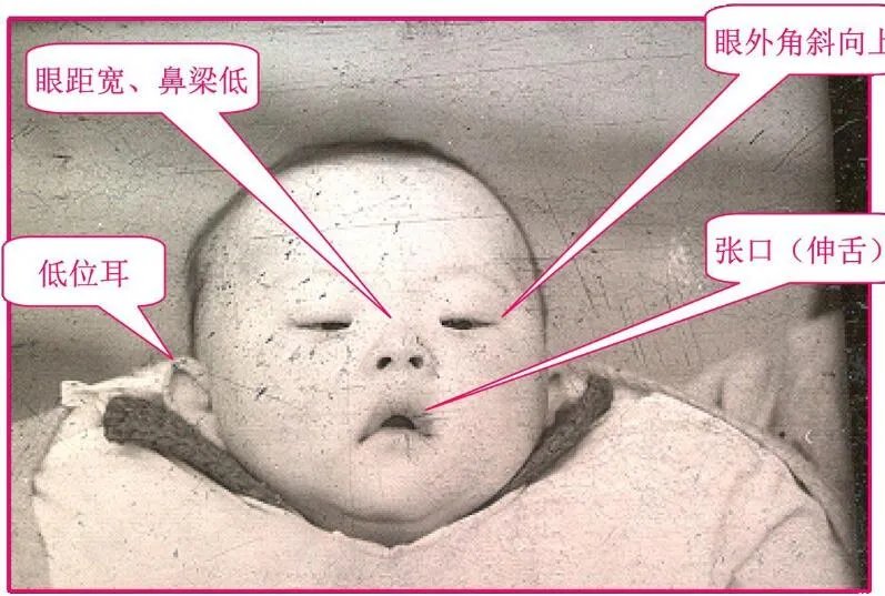 国际脸什么意思是什么病 弱智国际脸是怎么造成的