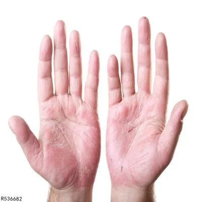手癣传染吗 手癣通过三个途径传染