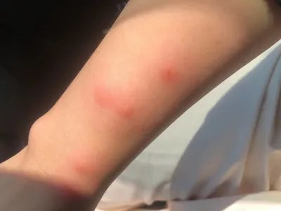 皮肤过敏红肿胳膊症状图片
